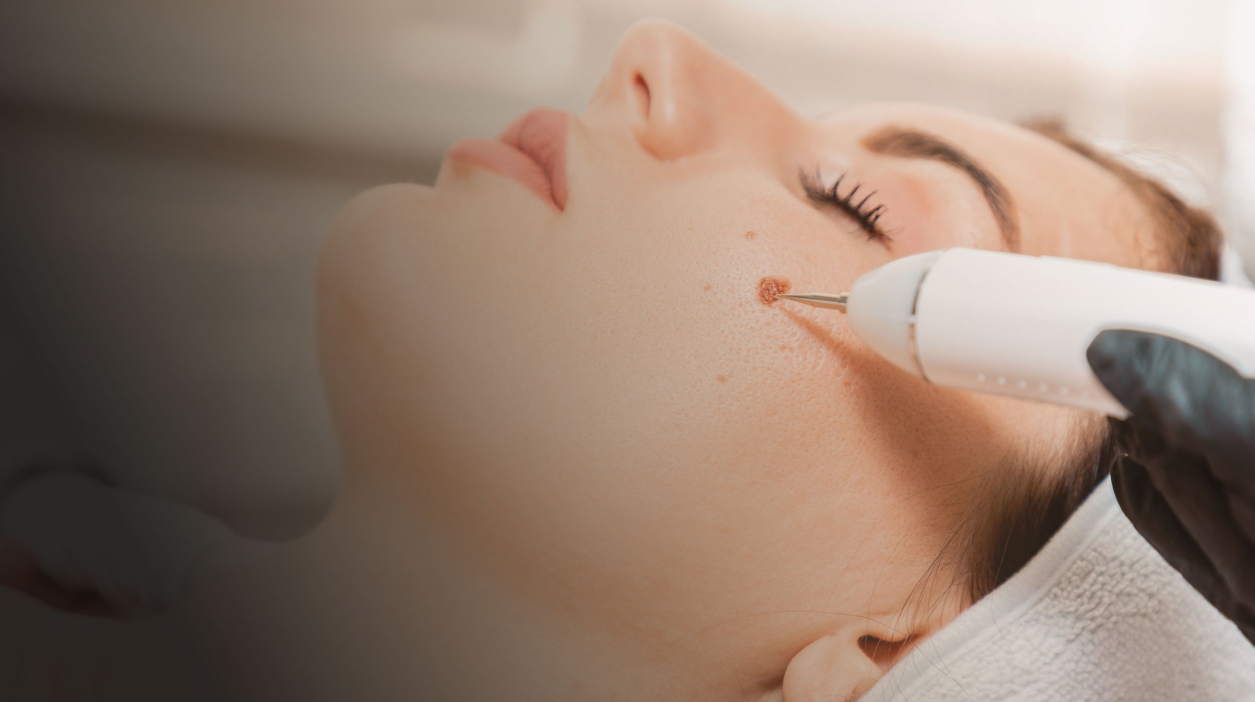 Close-up of a woman's face during a wart removal treatment