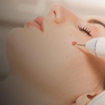 Close-up of a woman's face during a wart removal treatment