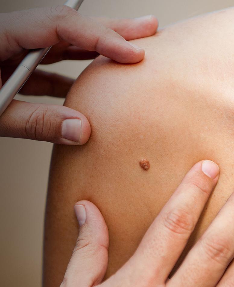 Doctor examining a mole on a patient's skin