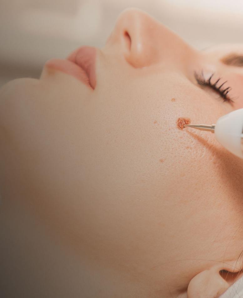 Close-up of a woman's face during a wart removal treatment